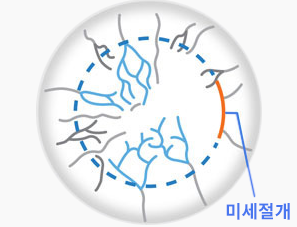 각막신경손상도3.png